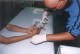 Bohaterski pacjent przytrzymuje sobie palec podczas zszywania
